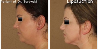 Woman treated with Liposuction - Here we did liposuction to remove excess submental ( neck) fat and used J plasma to tighten the skin