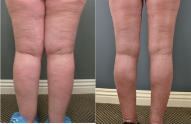 45-54 year old woman treated with Liposuction - Woman suffering from Lipedema undergoes liposuction surgery to remove the diseased fat from her calves, ankles and thighs.