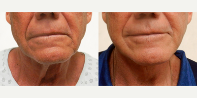 Man treated with Facelift - Man treated with Facelift