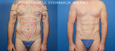 Man treated with Bicep Implants - Man treated with Bicep Implants