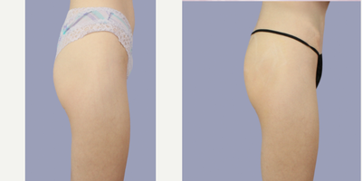 18-24 year old woman treated with Renuva - Nonsurgical BBL w/ Renuva
