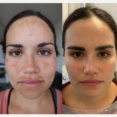 25-34 year old woman treated with Obagi Nu-Derm - Before and two months after treatment for hyperpigmentation