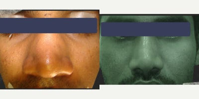 18-24 year man treated with Asian Rhinoplasty - 18-24 year man treated with Asian Rhinoplasty