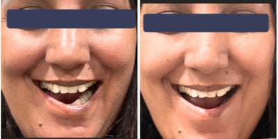 32 year old woman underwent smile correction with threads - 32 year old woman underwent smile correction with threads