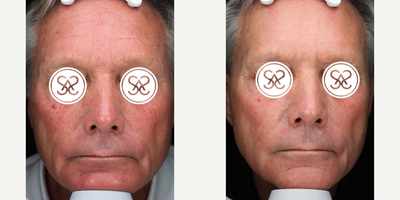 65-74 year old man treated with BroadBand Light (BBL) - Patient received 6 BBL treatments over 2 years. The second photo is 1 month after his last treatment.