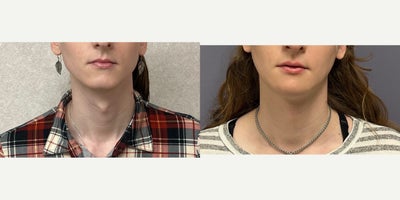 25-34 year old woman treated with Adam's Apple Reduction - This young lady underwent adam's apple reduction/chondrolarygoplasty.