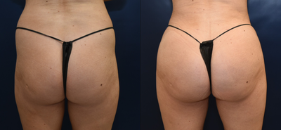 25-34 year old woman treated with Brazilian Butt Lift - Buttocks AugmentationThis patient desired more volume to her buttocks and hip dips to provide a more round appearance. Post-op timeline: 6 weeksAge: Between 23 and 29 years oldGender: Transgender femaleTechnique: Liposuction with Fat Transfer to Buttocks