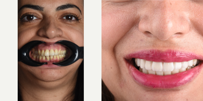 35-44 year old woman treated with Smile Makeover, Porcelain Veneers, Dental Bridge - Our patient had ill fitting old bridges and poor esthetic. We made her a digital smile design and delivered zirconia crowns on teeth to achieve an ideal esthetic result.