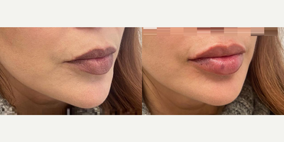 Woman treated with Lip Fillers - Woman treated with Lip Fillers