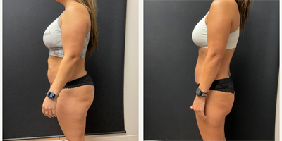35-44 year old woman treated with Ozempic for Weight Loss - Patient has lost 30lbs in 6 months on the Skinny Shot (Semaglutide)