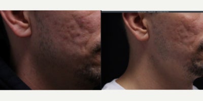Man treated with UltraClear Laser - Man treated with UltraClear Laser