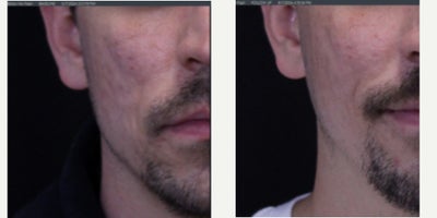 Man treated with UltraClear Laser - Man treated with UltraClear Laser