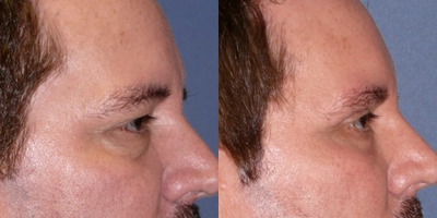 45-54 year old man treated with Eyelid Surgery - eyelid lift