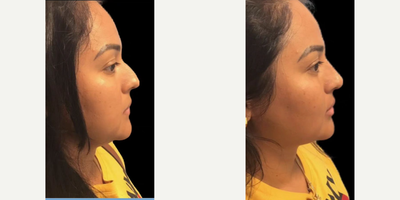 Woman treated with Nonsurgical Nose Job - Transformed by the art of liquid rhinoplasty & facial rejuvenation. Major profile upgrade thanks to the magic hands of Dr. Wolf