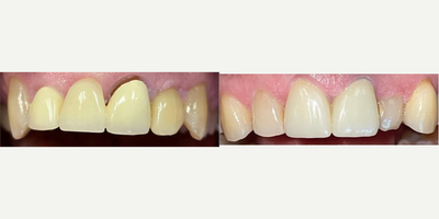 Treated with Dental Bridge - Treated with Dental Bridge.