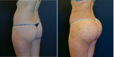 25-34 year old woman treated with Butt Lift - The patient had 548cc silicone butt implants and 350cc of fat transfer per side.  She also underwent liposculpting of the waist.  The pictures show her at one week post-op from her butt augmentation.  The combination of fat transfer, liposculpting and butt implants transforms her from square to hourglass figure!