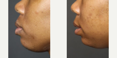 25-34 year old woman treated with Lip Reduction - 27-years-old woman treated with Lip ReductionWeight: 135 pounds | Height: 56 | BMI: 21.8 | Time After Surgery: 1 month