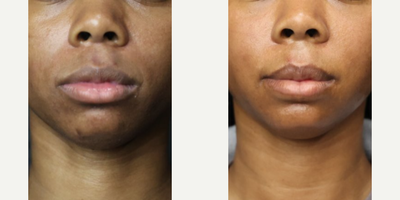 25-34 year old woman treated with Lip Reduction - 27-years-old woman treated with Lip ReductionWeight: 135 pounds | Height: 56 | BMI: 21.8 | Time After Surgery: 1 month