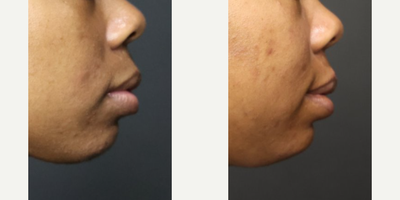 25-34 year old woman treated with Lip Reduction - 27-years-old woman treated with Lip ReductionWeight: 135 pounds | Height: 56 | BMI: 21.8 | Time After Surgery: 1 month