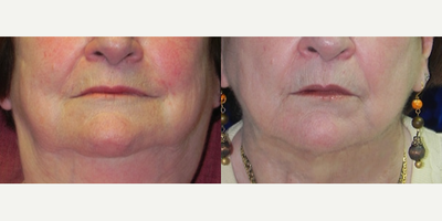 Woman treated with ThermiTight - Frontal view of 70 year-old female with Cervical Liposis (excessive fatty tissue) and skin redundancy in the neck and jawline. She underwent a Neck and Jowl Liposuction followed by a FaceTite /NeckTite subdermal radiofrequency skin tightening procedure along with a tiny SkinTrim TM  a procedure as invented and trademarked by Dr. Petropoulos. She is shown here 3 months after her procedure.