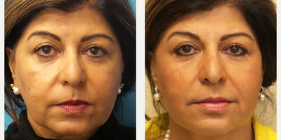 60 year old woman treated with Radiesse - This patient had a Radiesse Lift.
