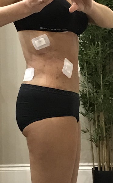 Traditional vs Vaser Liposuction In Adelaide - Cosmos Clinic