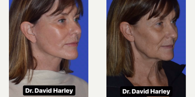 Woman treated with Facelift, Neck Lift - What is the meaning of an extended deep plane facelift and neck lift?As many of our well educated patients understand, a deep plane facelift technique is carried out by performing surgical dissection in the plane deep to the SMAS tissue layer and the platysma muscle.As a result of this dissection, ligaments are released in the cheek and the lateral neck to allow for greater mobilization of the deep structures and therefore a more natural result.When the term extended is used to describe the type of deep plane surgery, it means that the dissection is carried out in this tissue plane all the way to the edge of the nose, and the edge of the mouth. This allows for the most extensive release possible, which results in improvement in the nasolabial fold, the marionette line, and even a very nice improvement in the ogee curve.These improvements occur along with sharpening of the jawline definition, tightening of the neck, and lifting of the jowls.Dr. David Harley is a board-certified facial plastic surgeon who specializes exclusively in facial rejuvenation procedures.Dr. Harley performs extended deep plane facelift and neck lift procedures, along with blepharoplasty, brow lift, and lip lift surgery, under local anesthesia in the office setting.These procedures are performed daily on patients around the country who travel in for their surgeries.We are grateful to this patient, and to the many others who have generously offered to share their photos.