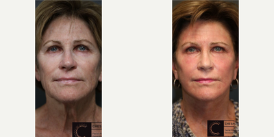 Woman in her 60s treated with Fractional Laser - Woman in her 60s treated with Fractional CO2Laser Resurfacing to improve her skin quality. She was bothered by thesagging tissue in her face, jawline and neck in addition to normal aging related changes in her skin quality.She also hadDeep Plane Faceliftto elevate all of her underlying soft tissue fat pads as one single unit and restore the gravity related aging changes
