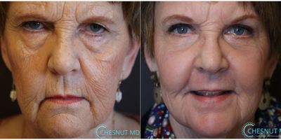 Woman treated with Fractional Laser - Woman treated with Fractional Laser as well as Brow Lift and Eyelid Surgery. Patient wanted to maintain a very natural, non-operated look while being more refreshed, awake and improveher skin.