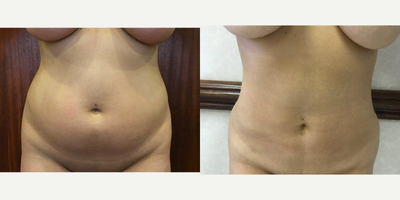 25-34 year old woman treated with Slim Lipo - 32-year-old lady underwent laser-assisted liposuction of the upper and lower abdomen.