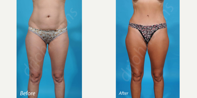 35-44 year old woman treated with Laser Liposuction - Bikini incision tummy tuck with laser liposuction of the flanks/love handles