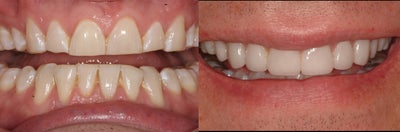 Prepless Veneers - No tooth reduction was used to apply ten Durathin Prepless Veneers to take years off teeth and restore youth to an aging smile.