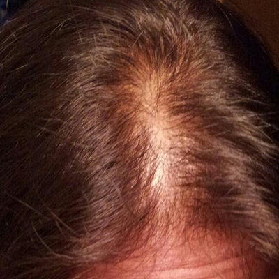 Hair thinning. Scalp almost visible. very upset? (photo) Doctor Answers ...