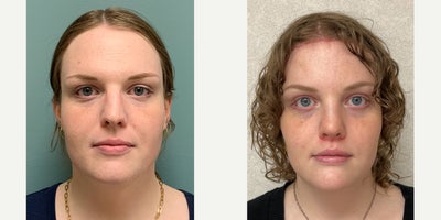 25-34 year old woman treated with Brow Lift, Brow Bone Reduction, Forehead Reduction, Facial Feminization Surgery, Rhinoplasty,  - This is a young lady who underwent forehead feminization surgery, septorhinoplasty, lip lift with augmentation and chin reduction.