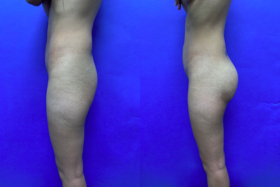 Woman treated with Butt Implants - Woman treated with Butt Implants