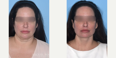 Woman treated with SMAS Facelift - Woman treated with Deep Plane Facelift, SMAS Facelift, and Neck Lift