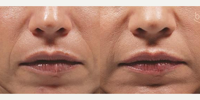 Bellafill Before & After Pictures - RealSelf