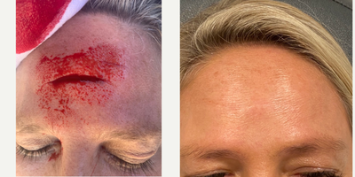 45-54 year old woman treated with Scar Removal - Young woman with a traumatic scar on the forehead required surgical scar repair by Dr. Karamanoukian followed by laser and RF resurfacing, Plato's Scar Serum, and scar modulation protocols at Kare Plastic Surgery