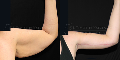 Woman treated with Arm Lift - Woman treated with Arm Lift to remove excess skin