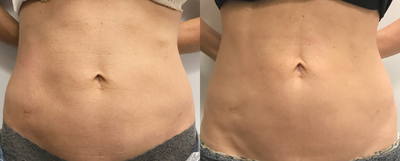 35-44 year old woman treated with Velashape - 35-44 year old woman treated with 3 sessions of Velashape. After photo taken 1 month after first treatment.