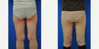 55-64 year old woman treated with Thigh Lift - Thigh lift