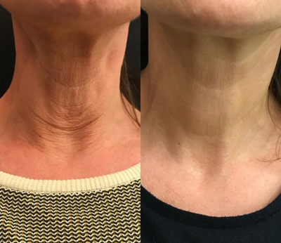 45-54 year old woman treated with Injectable Fillers - Profhilo, injectable hyaluronic acid injections. 2 treatments, 28 days apart to help with skin laxity.
