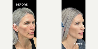 Woman treated with Dermal Fillers - Woman treated with Dermal Fillers