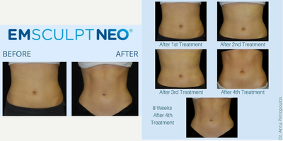 35-44 year old woman treated with Emsculpt - 8 weeks after 4th treatment!