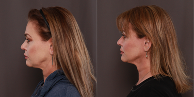 45-54 year old man treated with MACS Facelift - Macslift