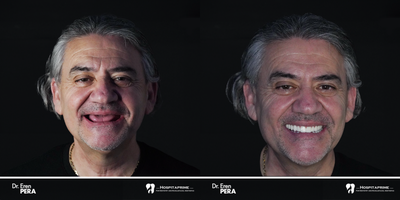 35-44 year old man treated with Dental Implants - hospitaprime