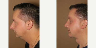 Man treated with Rhinoplasty - Man treated with Rhinoplasty