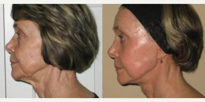 Woman treated with Laser Resurfacing - Laser Skin Resurfacing