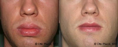 Lip Reduction  - 
	Lip Reduction
