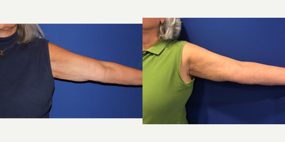 65-74 year old woman treated with Ultherapy - My 68 year old patient wanted a non invasive skin tightening procedure to tone and tighten inner arms and thighs. Here she is 8 months post treatment after 1 session.